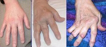 Artritis erreumatoidea duten eskuak.