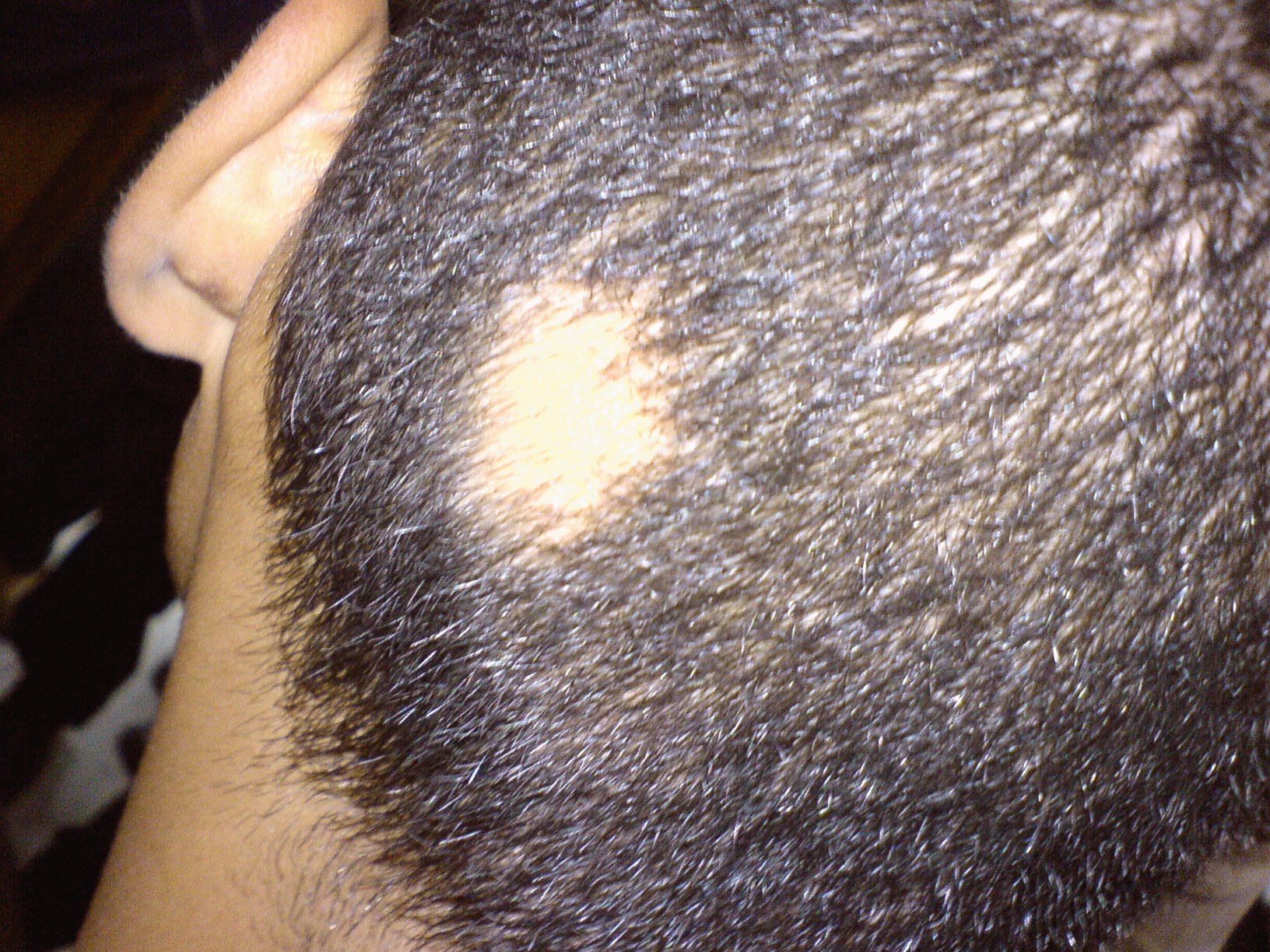 Alopecia areata edo burusoiltasun zirkunskribatua.