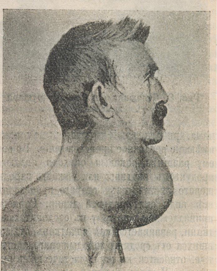 Tiroideko minbiziaren irudia, 1914koa
