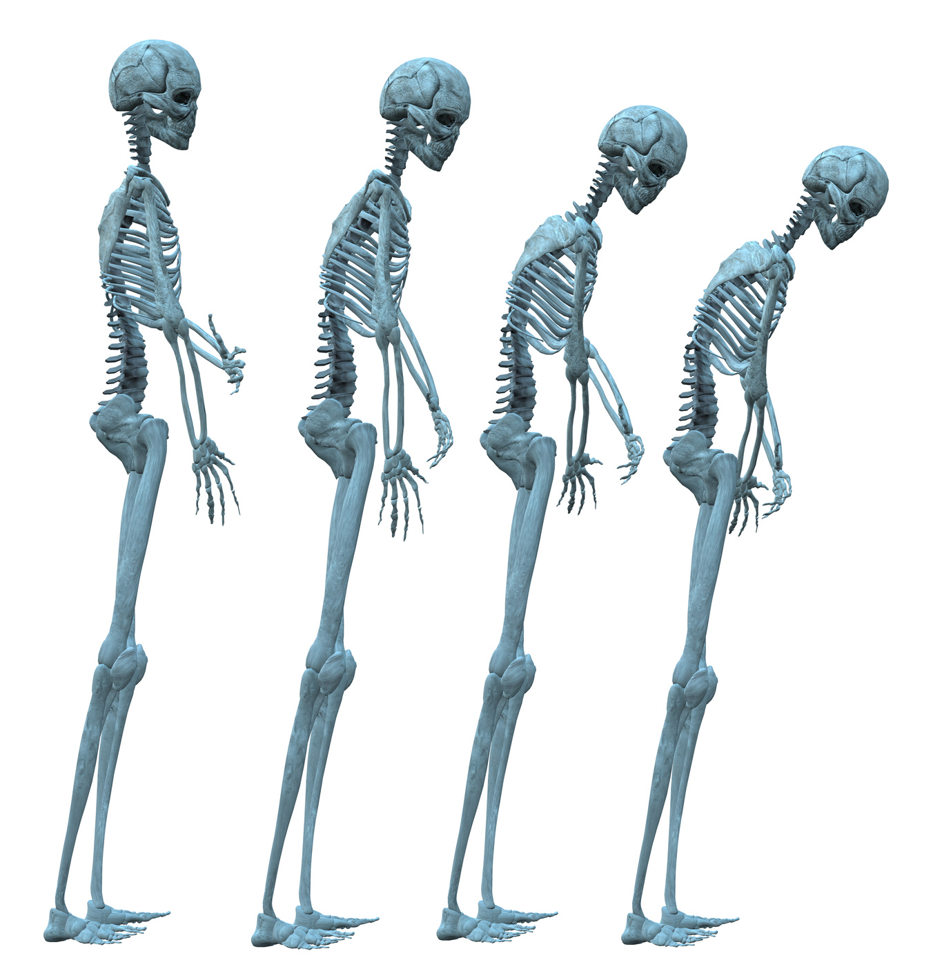 Osteoporosiaren garapena